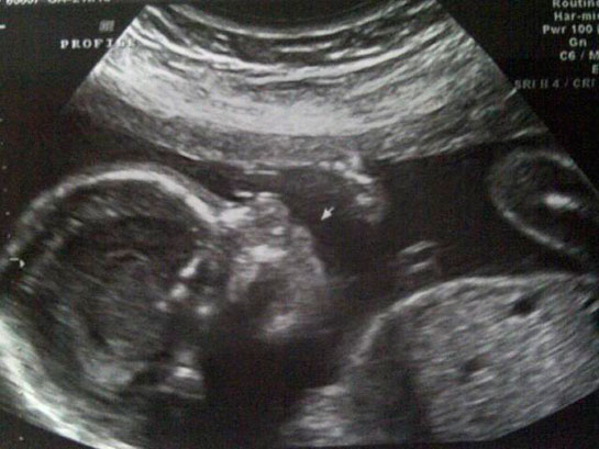 21 Haftalık Gebelik