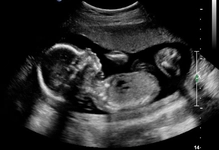 20 Haftalık Gebelik 20 Haftalık Gebelik