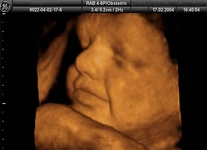 35 Haftalık Gebelik 35 Haftalık Gebelik