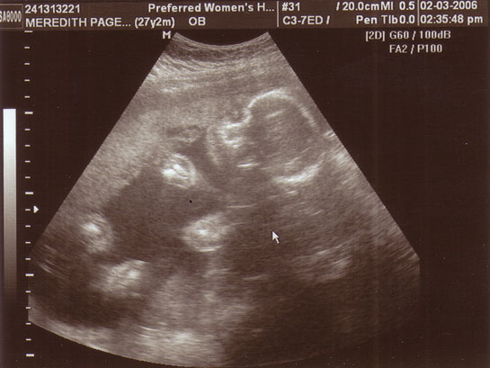 25 Haftalık Gebelik