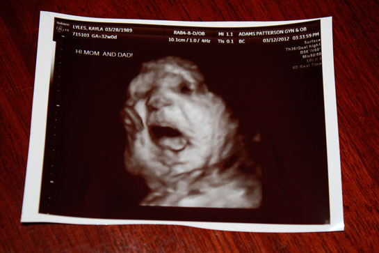 31 Haftalık Gebelik