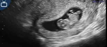 9 Haftalık Gebelikte Annede ve Bebekte Yaşanan Değişimler 9 Haftalık Gebelikte Annede ve Bebekte Yaşanan Değişimler